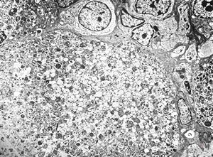 F,1y. | epulis congenitalis (granulomatosa) F,1y. | epulis congenitalis (granulomatosa)